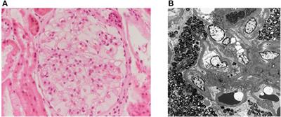 Discordant renal progression of Fabry disease in male monozygotic twins: a case report